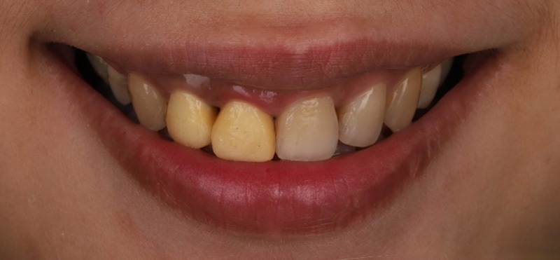 陶瓷貼片-牙齒矯正後-牙齦高低不齊-臉部外觀照-沈志容醫師-桃園
