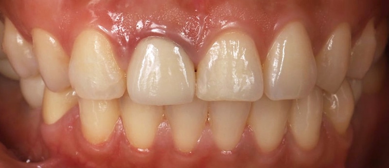 陶瓷貼片-牙齒矯正後-牙齦高度不對稱-沈志容醫師-桃園