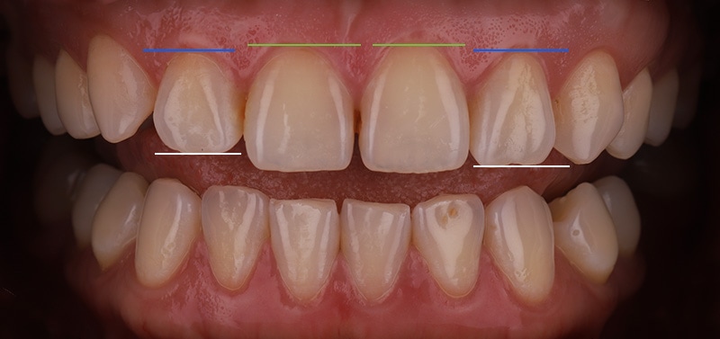 陶瓷貼片-牙齒矯正後-牙齦高度與牙齒切緣處高低比較-沈志容醫師-桃園
