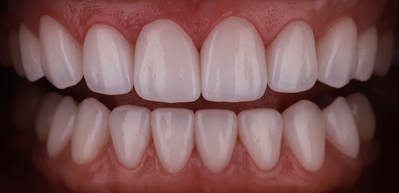陶瓷貼片-牙齒矯正後-瓷牙貼片快速更改牙齒長度-沈志容醫師-桃園