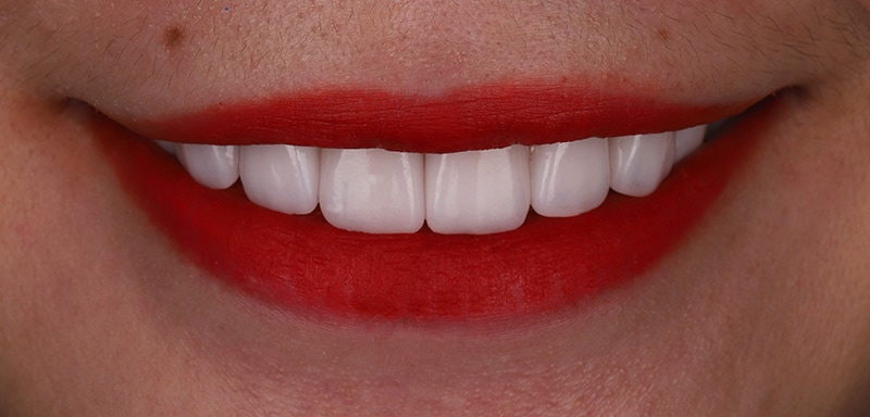 陶瓷貼片-牙齒矯正後-瓷牙貼片調整牙齒長度與對稱角度-沈志容醫師-桃園