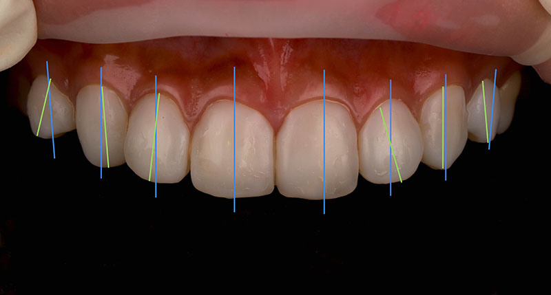 陶瓷貼片-牙齒貼片失敗-原牙齒與貼片預計的長軸線比較-沈志容醫師-桃園