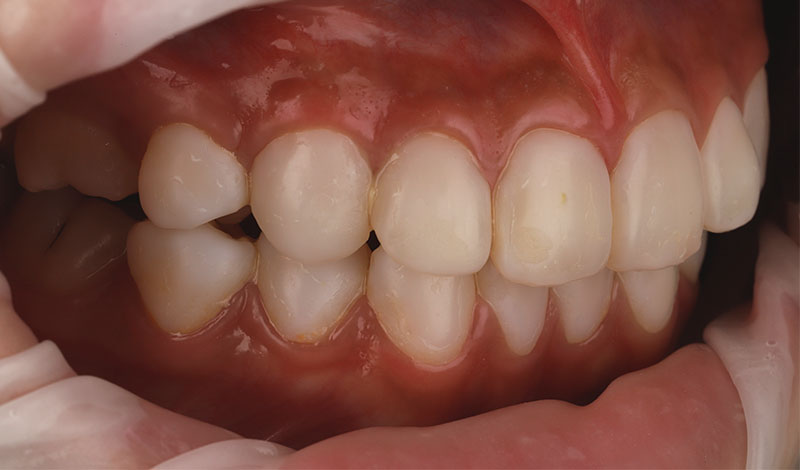 陶瓷貼片-牙齒貼片失敗-樹脂貼片拆換-陶瓷貼片前-右側牙齒近照-沈志容醫師-桃園