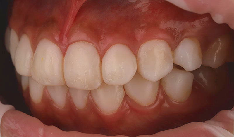 陶瓷貼片-牙齒貼片失敗-樹脂貼片拆換-陶瓷貼片前-左側牙齒近照-沈志容醫師-桃園