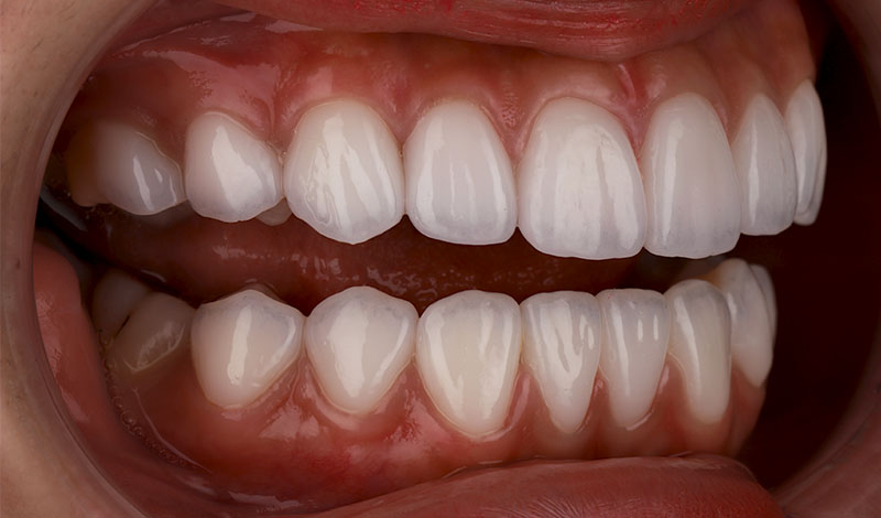 陶瓷貼片-牙齒貼片失敗-樹脂貼片拆換-陶瓷貼片後-右側牙齒近照-沈志容醫師-桃園