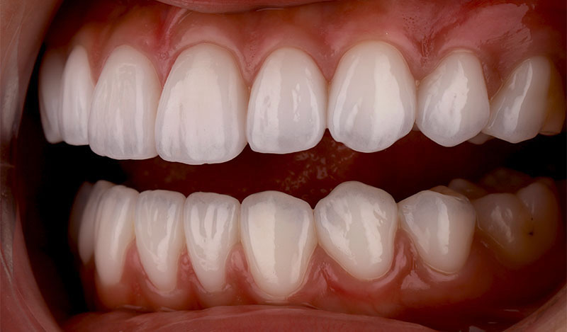 陶瓷貼片-牙齒貼片失敗-樹脂貼片拆換-陶瓷貼片後-左側牙齒近照-沈志容醫師-桃園