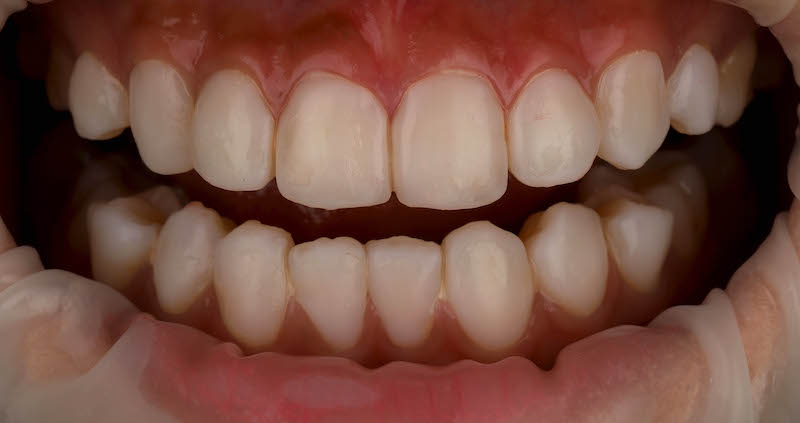 陶瓷貼片-牙齒貼片失敗-療程前失敗的樹脂貼片-沈志容醫師-桃園