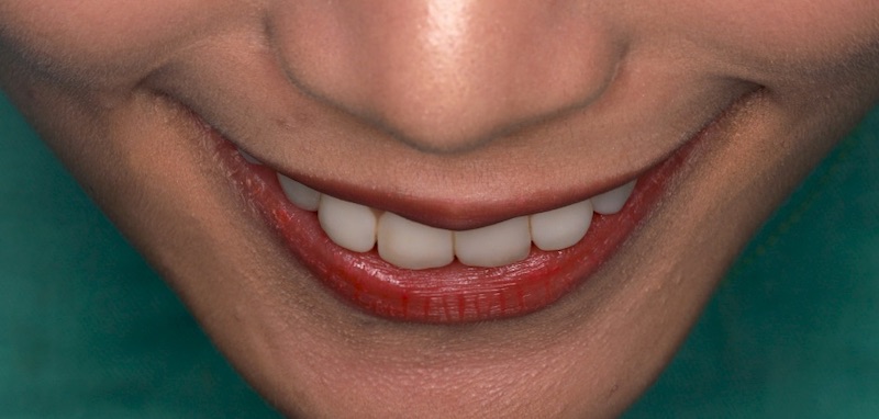 陶瓷貼片-牙齒貼片失敗-療程前樹脂貼片-牙齒角度外散-沈志容醫師-桃園