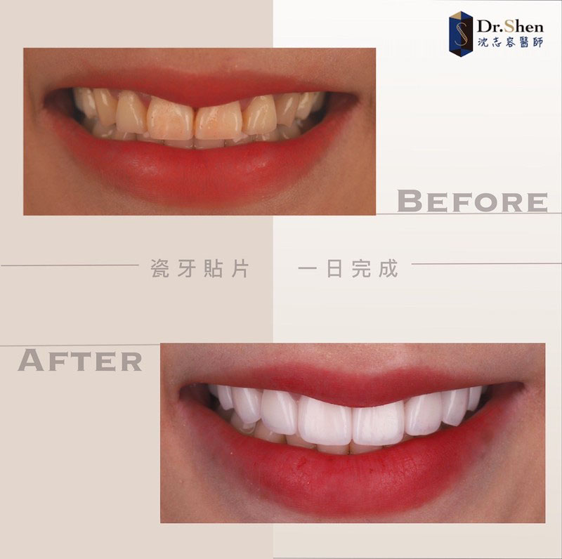 牙齒黃-牙齒矯正-牙齒美白-陶瓷貼片前後上排牙齒比較-沈志容醫師-桃園