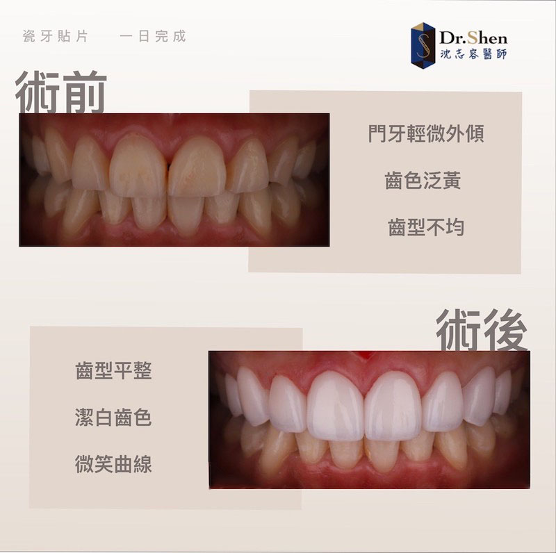 牙齒黃-牙齒矯正-牙齒美白-陶瓷貼片前後前牙微笑曲線比較-沈志容醫師-桃園