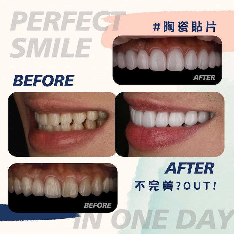 門牙缺角-修補-牙齒-微笑線-陶瓷貼片前後比較-沈志容醫師-桃園