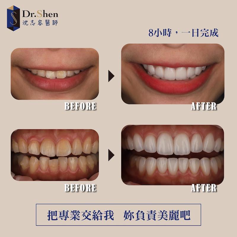 門牙矯正-牙齒黃-微笑設計-瓷牙貼片前後上排牙齒及牙齒咬合比較-沈志容醫師-桃園