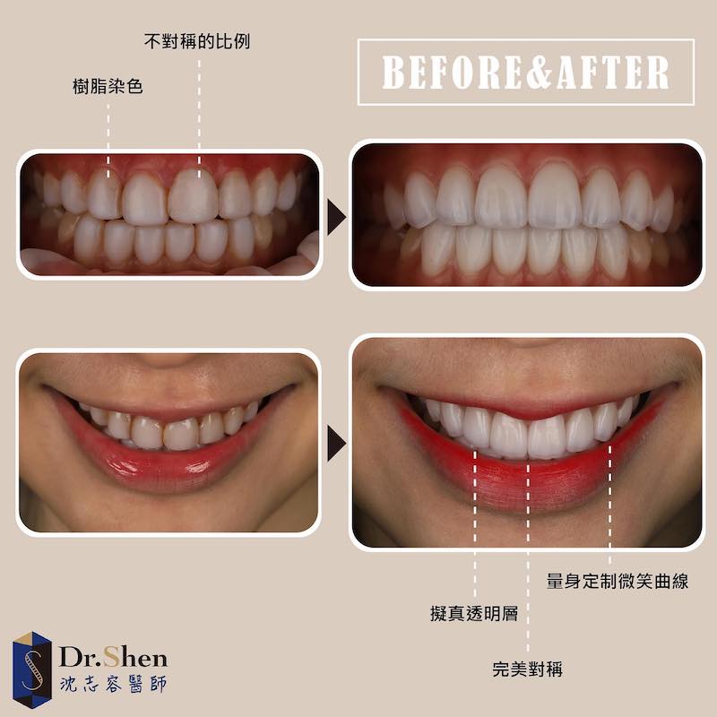 樹脂貼片-陶瓷貼片-dsd微笑設計-療程前後牙齒外觀比較-馬來西亞-張安琪-沈志容醫師-桃園