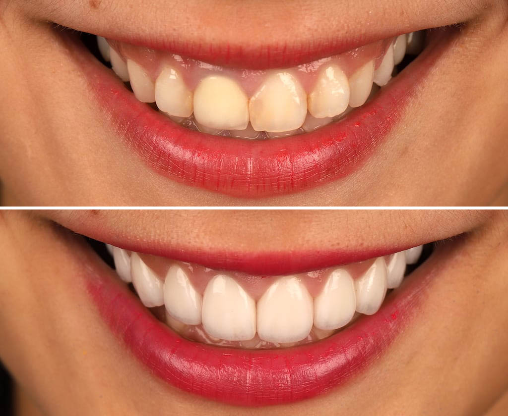瓷牙貼片價格-牙齒貼片缺點-牙齒美白推薦診所選擇-瓷牙貼片治療前後比較-2022