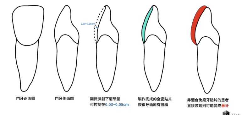 陶瓷貼片-瓷牙貼片-後遺症-後悔-免磨牙瓷牙貼片示意圖-沈志容醫師-桃園