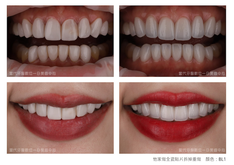 全瓷貼片拆掉重做前後比較：治療前牙齒顏色死白外型不佳；重做陶瓷貼片後，牙齒變得白皙透亮且微笑曲線更加自然