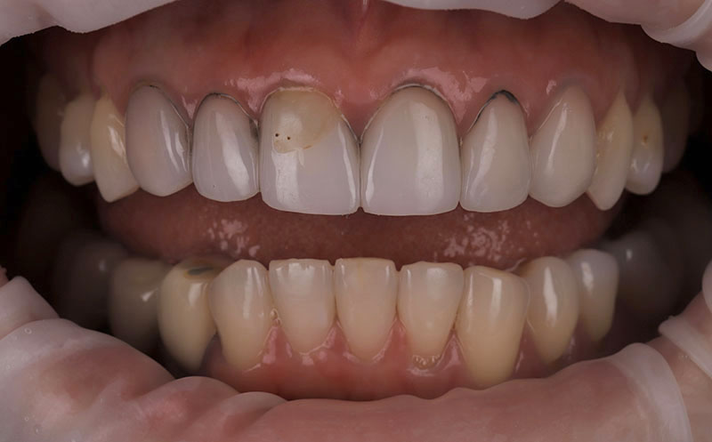 廉價陶瓷貼片產生邊緣染色後遺症，門牙破損用樹脂填補又造成染色