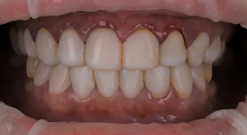 患者因不良樹脂貼片產生後遺症，牙齦嚴重紅腫發炎