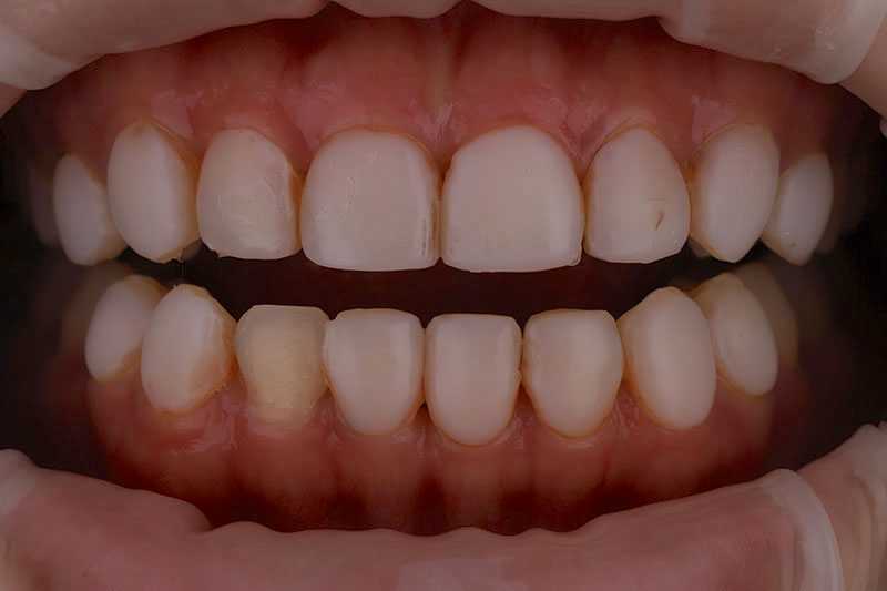 樹脂製的牙齒貼片失敗，外觀呈現染色、破損甚至有脫落狀態