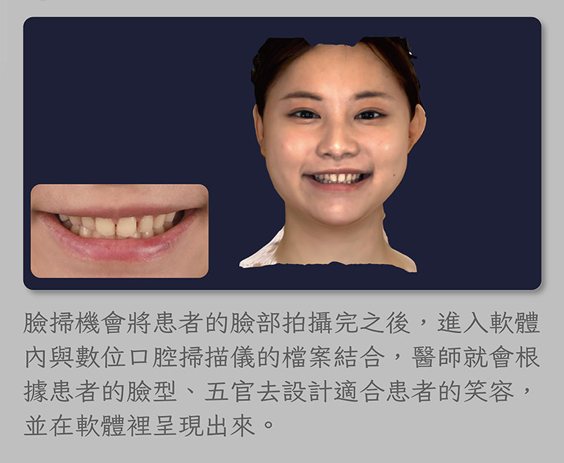 臉掃機拍攝完臉部照片後，可與數位口腔掃描儀的檔案結合，讓醫師根據患者的臉型、五官來設計笑容並呈現在軟體中
