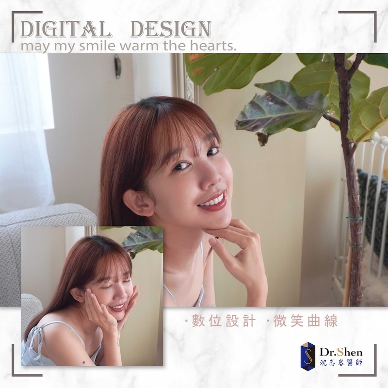 冷光美白-陶瓷貼片-牙齒美白-微笑設計-療程後笑容-4-沈志容醫師-桃園 完成陶瓷貼片療程,羚安露出自然亮白的自信笑容