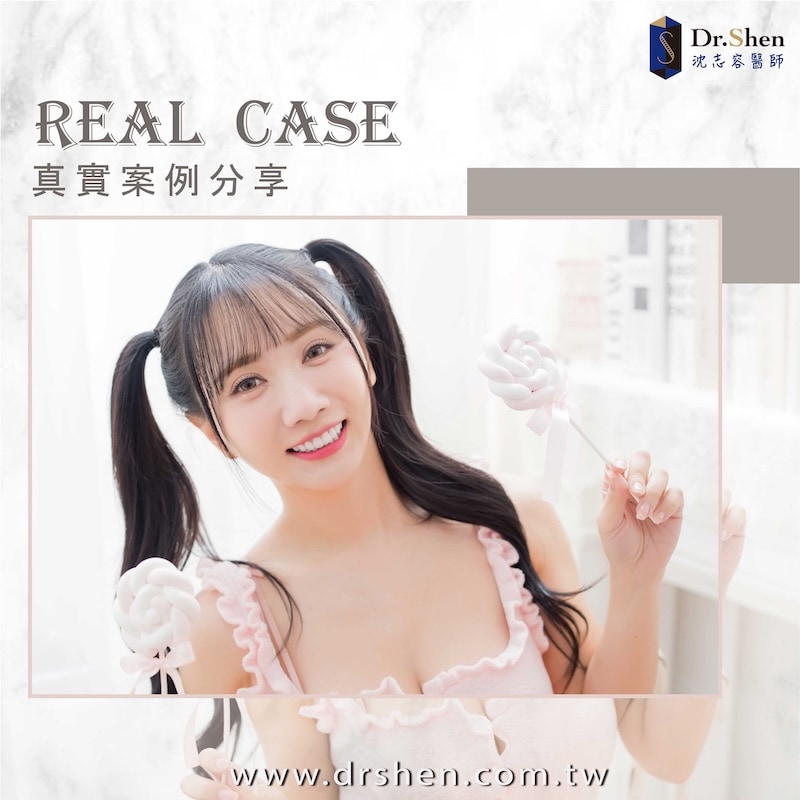 牙齒不對稱-牙齒亂-陶瓷貼片-味全龍啦啦隊-小珍奶-療程後笑容-1-沈志容醫師-桃園 味全龍啦啦隊小珍奶笑容特寫,完成陶瓷貼片後展現自然透亮牙齒與自信甜美氣質