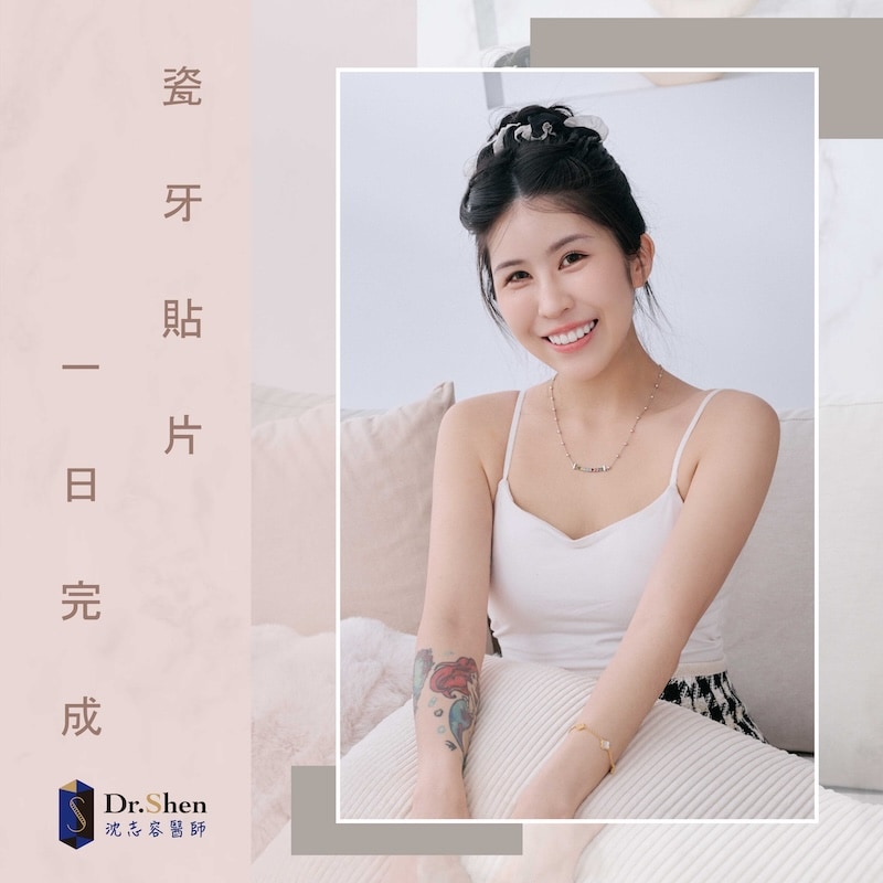 完成陶瓷貼片與水雷射牙齦療程後，柔柔展現白皙整齊的牙齒與自然自信笑容