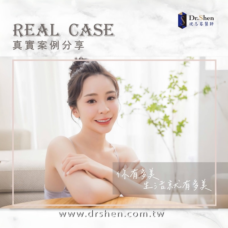直播主思辰完成陶瓷貼片療程，露出自信燦爛笑容與自然透亮牙齒