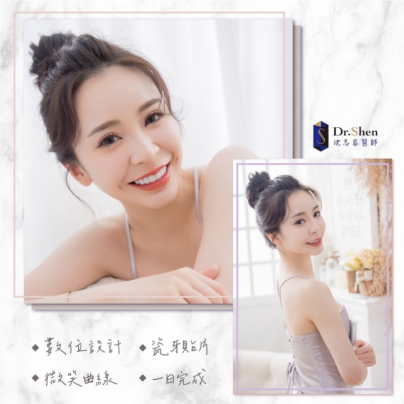 直播主思辰完成陶瓷貼片療程，露出自信燦爛笑容與自然透亮牙齒