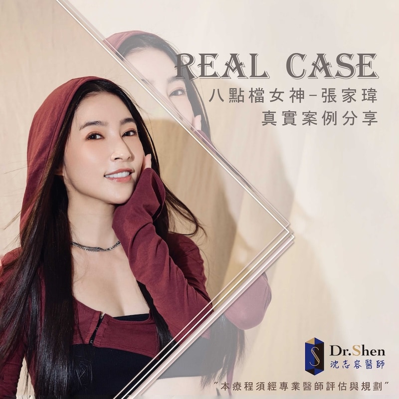 藝人張家瑋八年前重做陶瓷貼片後，笑容至今依然自然透亮，展現八點檔女神的專業自信
