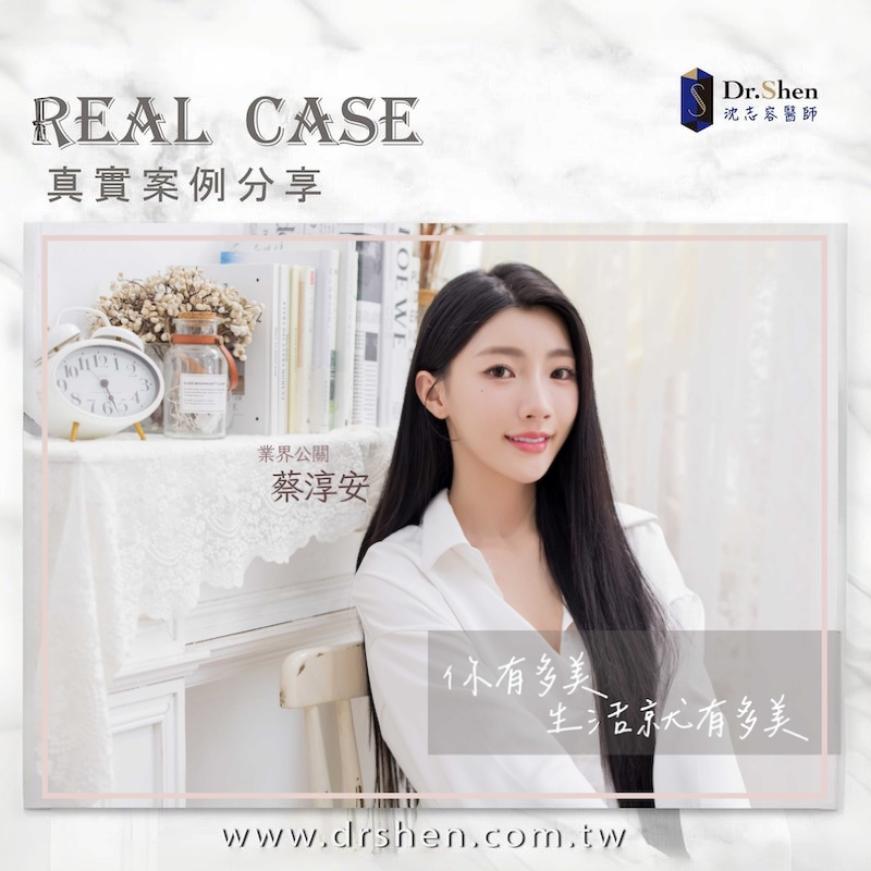 完成陶瓷貼片與水雷射牙齦後，患者展現自然潔白笑容與自信氣質