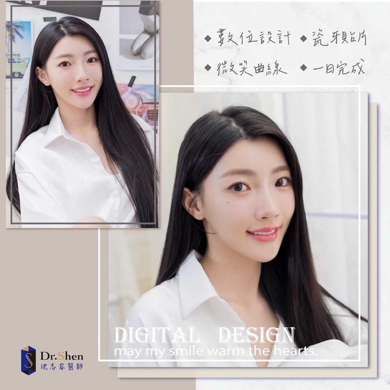 完成陶瓷貼片與水雷射牙齦後，患者展現自然潔白笑容與自信氣質