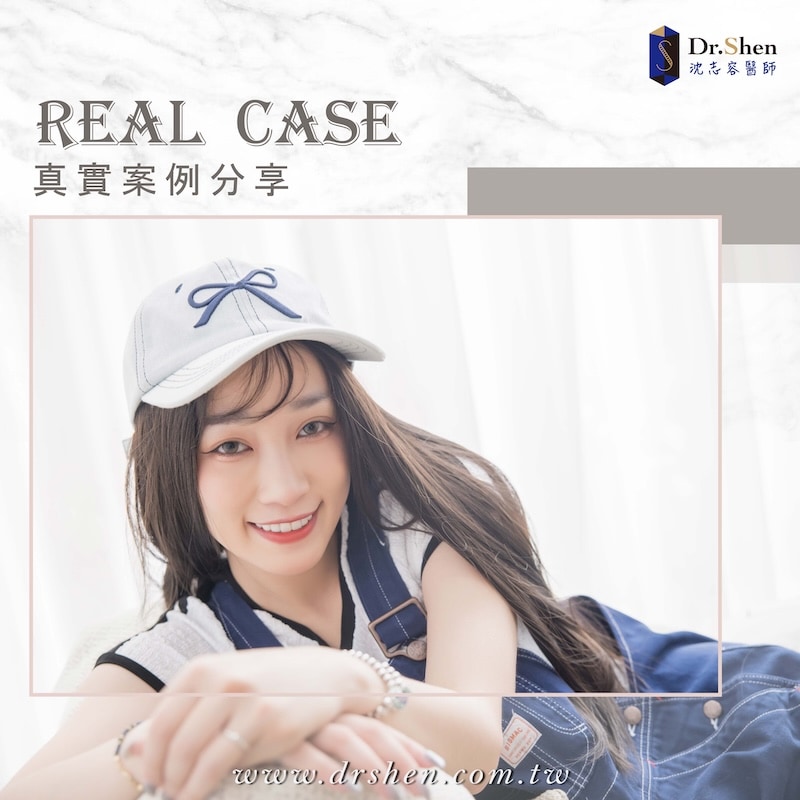 牙齒大小不一-牙齒不對稱-牙齒黃-陶瓷貼片-劉萱IRIS-療程後笑容-1-沈志容醫師-桃園 遊戲實況主劉萱完成陶瓷貼片療程後的笑容,牙齒色澤自然透亮、齒型對稱整齊,呈現自信迷人的微笑曲線