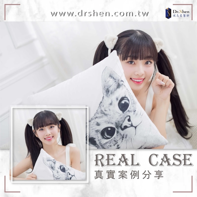 陶瓷貼片-水雷射牙齦-中信兄弟啦啦隊-Passion Sisters-維尼-療程後笑容-1-沈志容醫師-桃園 中信兄弟啦啦隊維尼完成陶瓷貼片與水雷射牙齦療程後的笑容,牙齒比例自然、線條勻稱,展現甜美自信形象