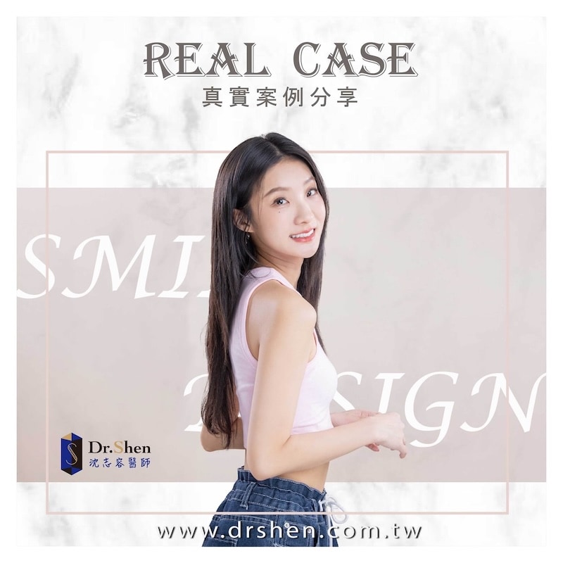 牙齒大小不一-牙齒美白-陶瓷貼片-陳華-療程後笑容-1-沈志容醫師-桃園 創作歌手陳華完成陶瓷貼片後展現自然自信笑容