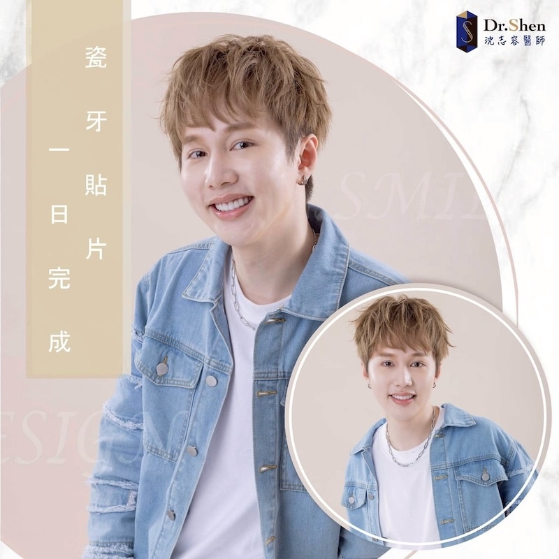 釘狀齒-牙齒縫隙大-陶瓷貼片-水雷射牙齦-王子境-療程後笑容-2-沈志容醫師-桃園 說唱歌手王子境完成陶瓷貼片與水雷射牙齦美容後展現自然自信笑容