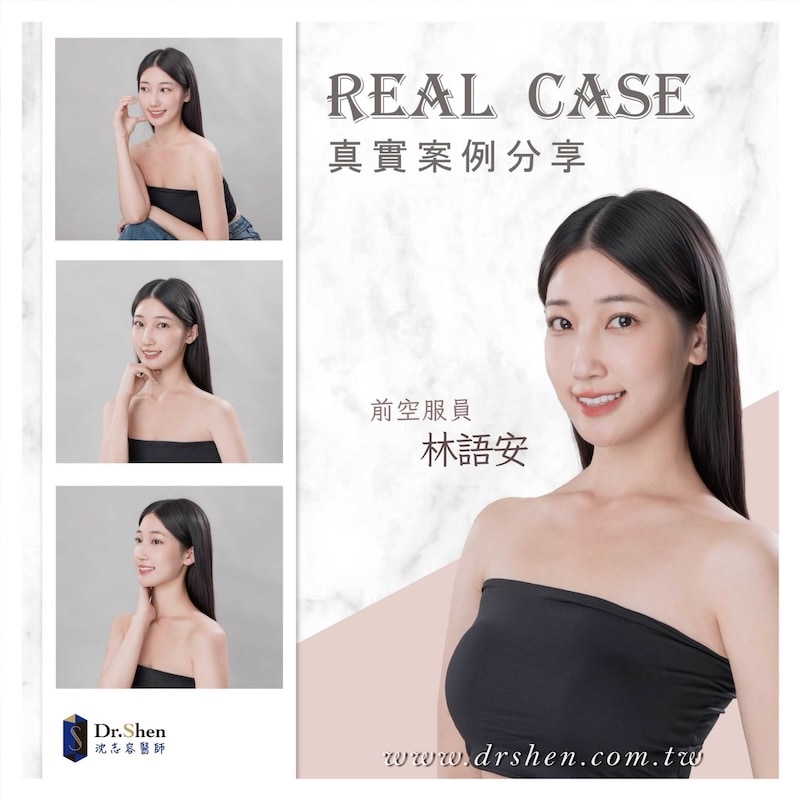 門牙縫隙-牙齒顏色不均-陶瓷貼片-空服員-林語安-療程後笑容-1-沈志容醫師-桃園 前空服員林語安完成陶瓷貼片後展現自然自信笑容